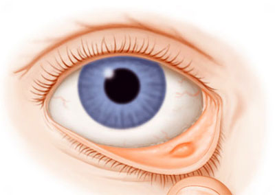 Лікування очних хвороб
