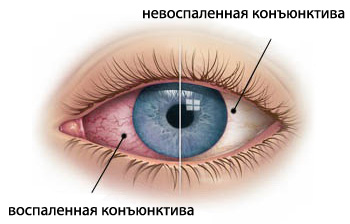 Болезни глаз — какие бывают заболевания глаз человека